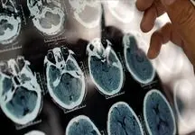 آلزایمر از ۴۰ سالگی در کمین است؛ روش‌های پیشگیری و عوامل مؤثر