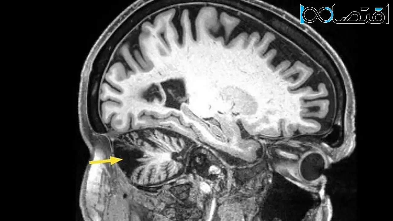 بهبود تحرک و تعادل یک بیمار، ۱۲ سال پس از سکته مغزی با تحریک مغناطیسی
