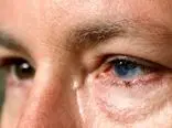 درمان آسیب‌های چشمی با سلول‌های بنیادی چشم یک شخص دیگر