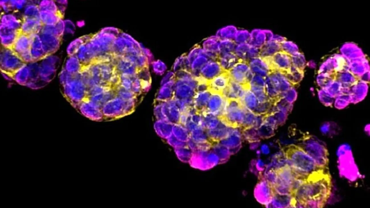 واکسن mRNAشخصی سازی شده برای درمان سرطان از راه رسید