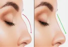 روش کوچک کردن سریع بینی در خانه با زنجبیل در 10 روز