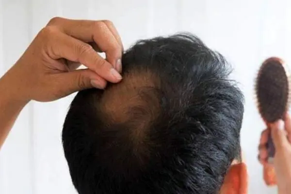 پایان ریزش مو فقط با این چند نکته ساده و اثربخش!