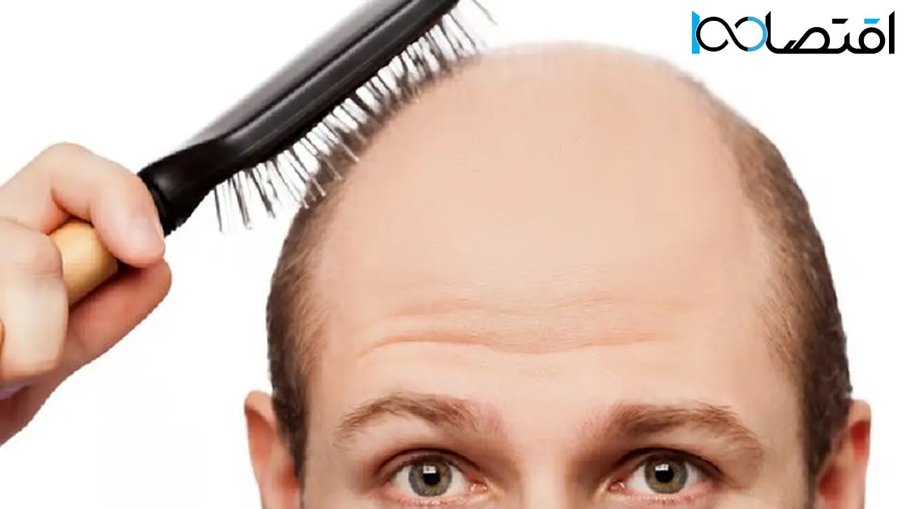 ژن‌های نادر عامل ریزش موی مردان شناسایی شدند