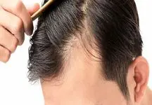 رازهای روانشناسی ریزش مو: از فشار روانی تا درمان!