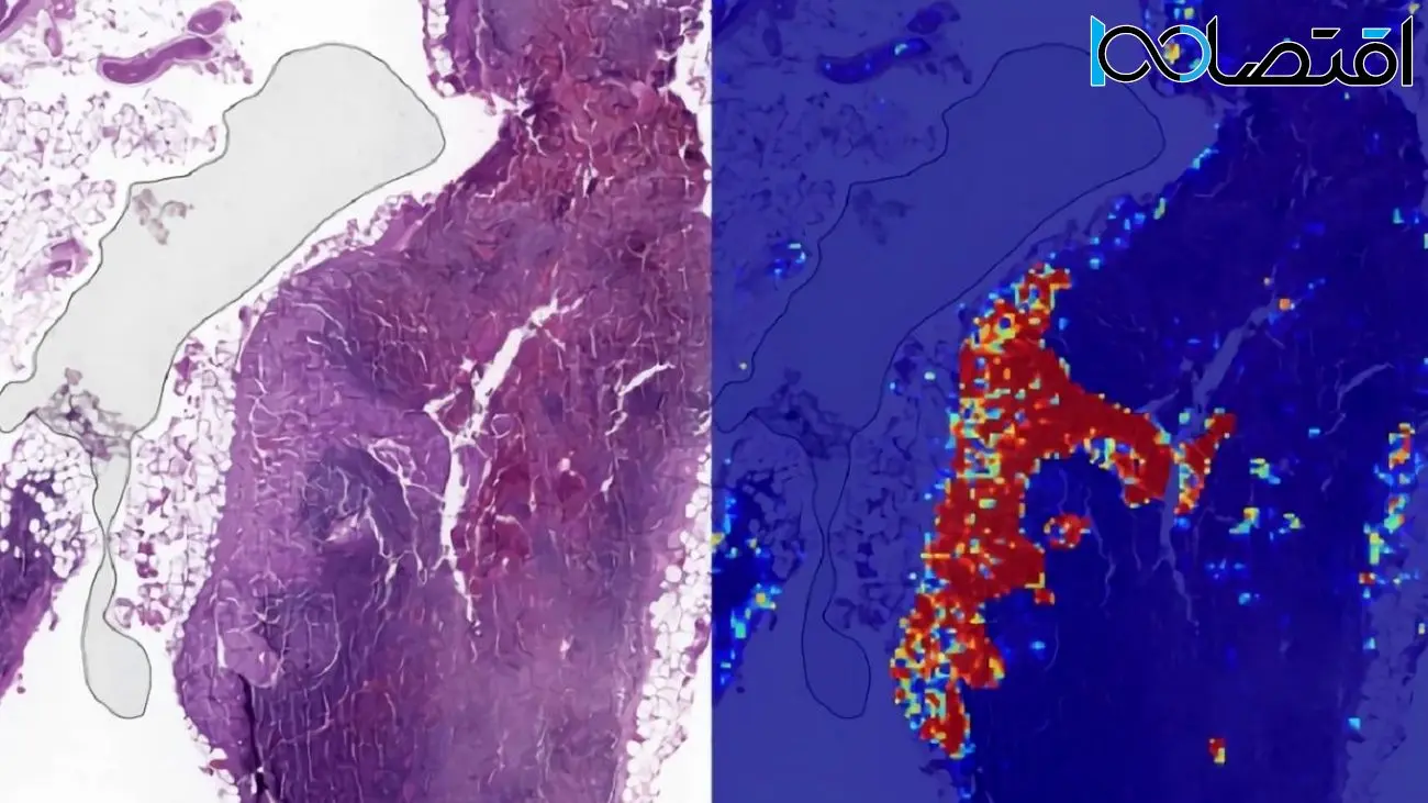 دقت هوش مصنوعی در تشخیص سرطان پستان بالاتر از رادیولوژیست‌ها است!