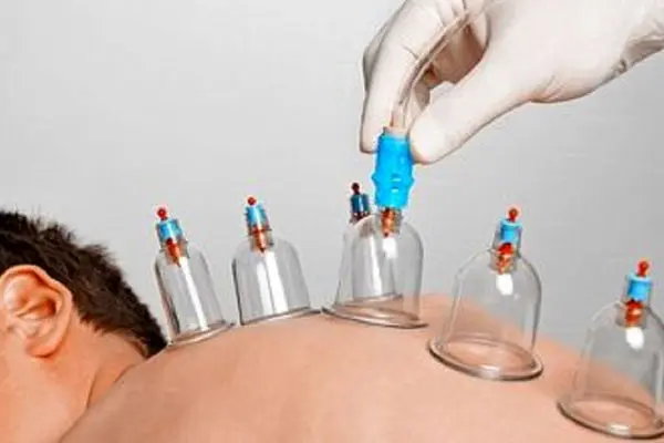 بهترین زمان حجامت ۱۴۰۳ + روزهای خوب برای حجامت سال ۱۴۰۳