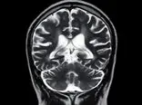 یک ناهنجاری مغزی مهم پساکرونا با «ام‌.آر.آی» خاص مشخص شد