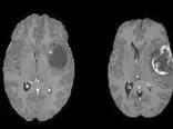 موفقیت ChatGPT در بهبود تشخیص تومور مغزی