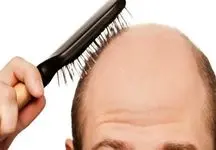 با این ویتامین، ریزش مو را برای همیشه متوقف کنید!