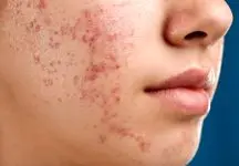 درمان آکنه با وصله ریز سوزن و اولتراساوند