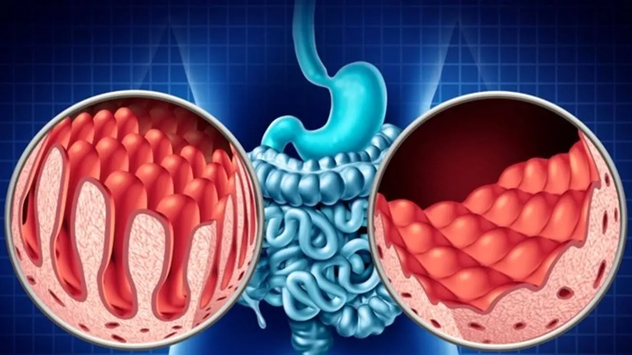 درباره «سلیاک»؛ بیماری که درباره اش کمتر می دانیم