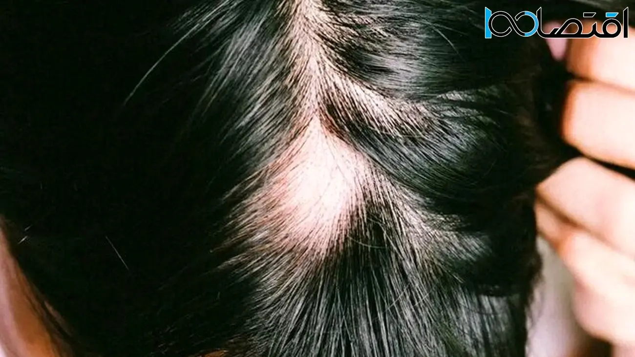 داروی جدید «فایزر» برای درمان ریزش مو