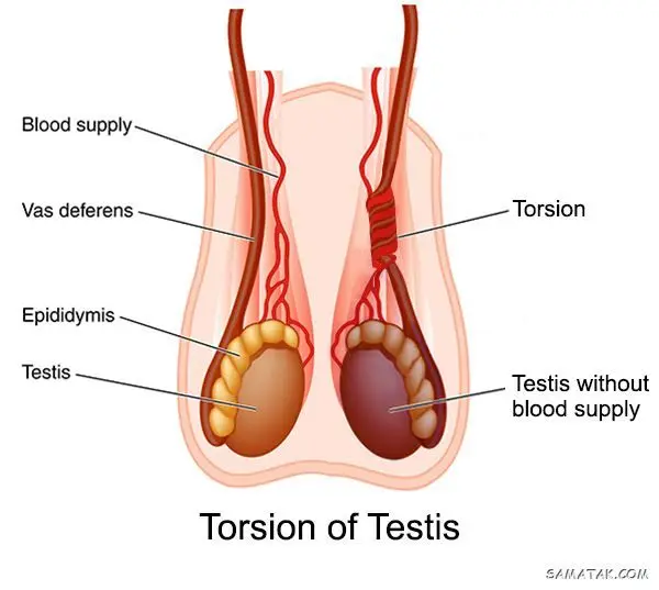 علت درد بیضه سمت راست | درمان درد بیضه سمت راست