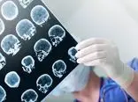 ضربه به سر ممکن است خطر مرگ زودهنگام را ۲ برابر کند