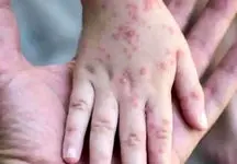 زنگ خطر آبله میمونی به صدا درآمد!