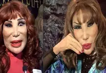 افراط در جراحی پلاستیک پوست این زن را از بین برده است + عکس