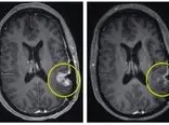 یک درمان جدید تومور مغزی را در عرض تنها ۵ روز از بین برد