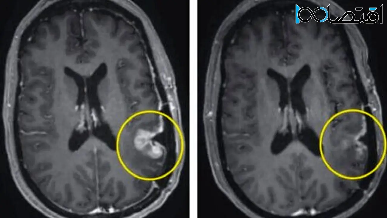یک درمان جدید تومور مغزی را در عرض تنها ۵ روز از بین برد