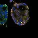 کشف مسیر جدیدی از مرگ سلول‌های سرطانی برای اولین بار