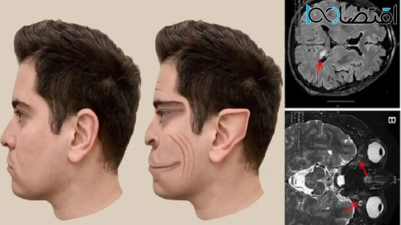 بیماری نادری که باعث می‌شود چهره افراد را شبیه به فیلترهای «تیک‌تاک» ببینید