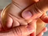 ویدئوی ترسناکی از دورهمی باکتری‌ها در کف دست یک کودک